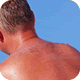 Sunburn Relief